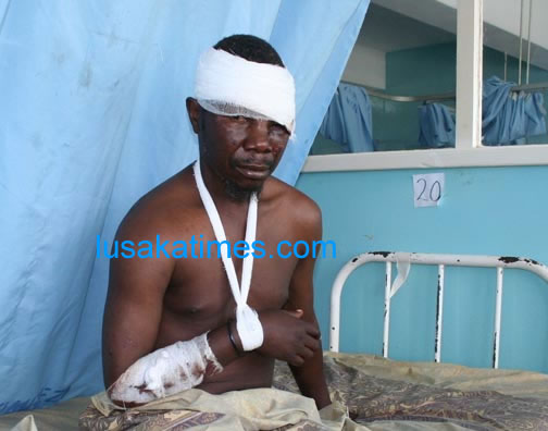 Zambia national women soccer team coach Frederick Kashimoto nursing injuries at Kitwe central hospital after he was hit by a fast moving taxi