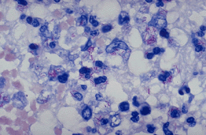 mycobacterium tb