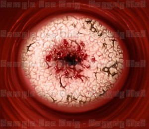 Cervical cancer Cervical cancer