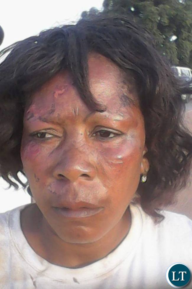 Injured UPND supporter