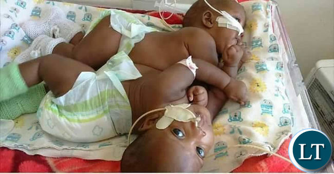 The conjoined twins