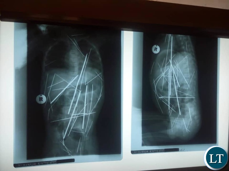 The Xray of the boy's body showing the wires and needles