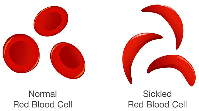 FDA Approves Revolutionary Cell-Based Gene Therapies for Sickle Cell Disease