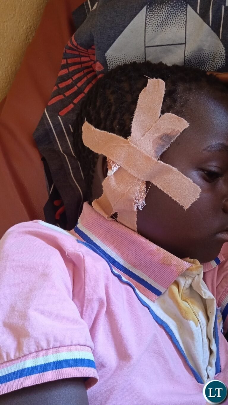 Hyena attacks 9-year-old in Lumezi