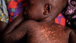 Cases of Measles rise in Shangombo District